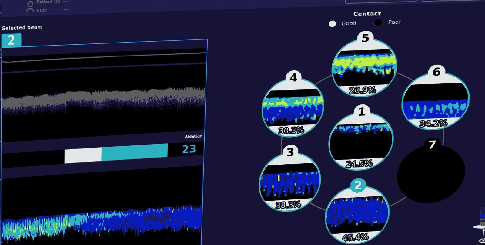 AblaView console during ablation: live PS-OCR M-mode traces and a seven-beam contact map showing per-beam tissue contact percentages.